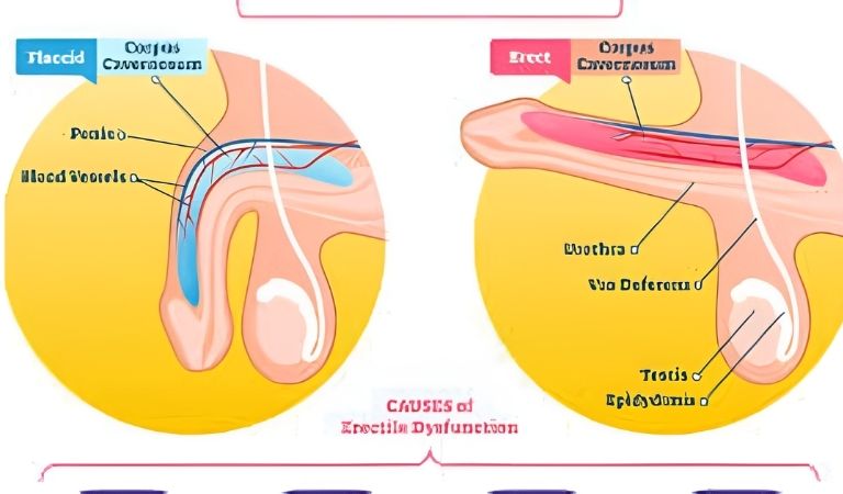 इरेक्शन-बढ़ाने-के-घरेलू-उपाय | Chetan Clinic Blog